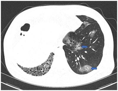 Pulmonary nocardiosis following COVID-19 in a patient with idiopathic pulmonary fibrosis and lung transplantation: a case report